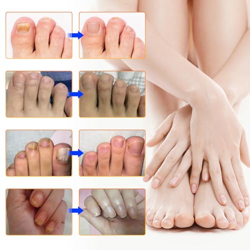Toenail Treatment Extra Strength, 32 Patch Nail Patches for Nail Treatment Overnight, Nail Repair for Damaged Nails, Nails Care Supplies, Restore Discoloration (32 Patch)